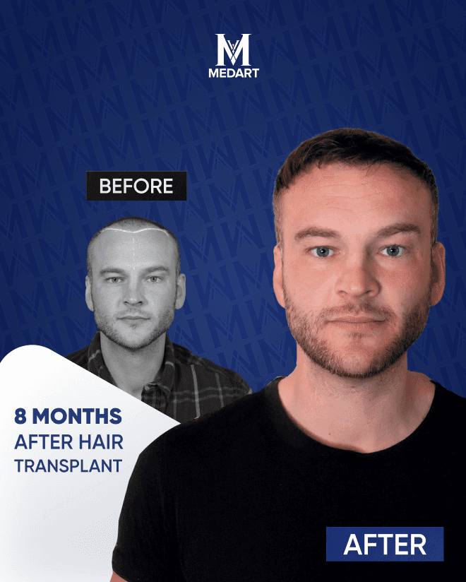Before After 3