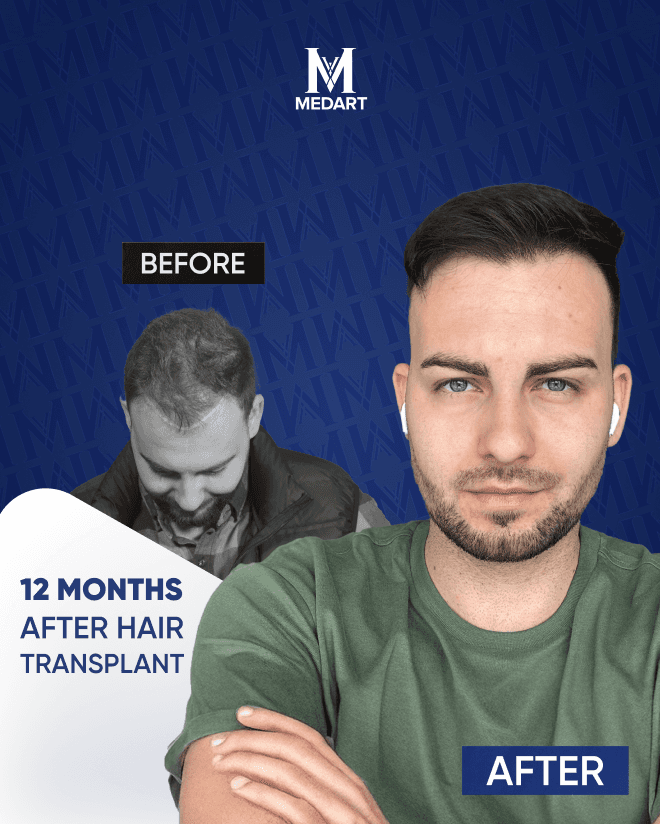 Before After 4