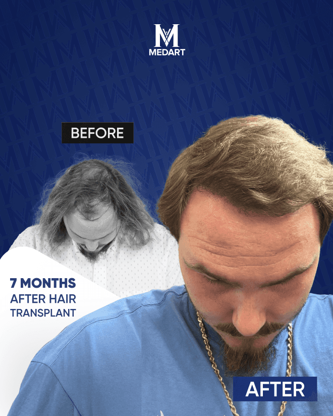 Before After 5