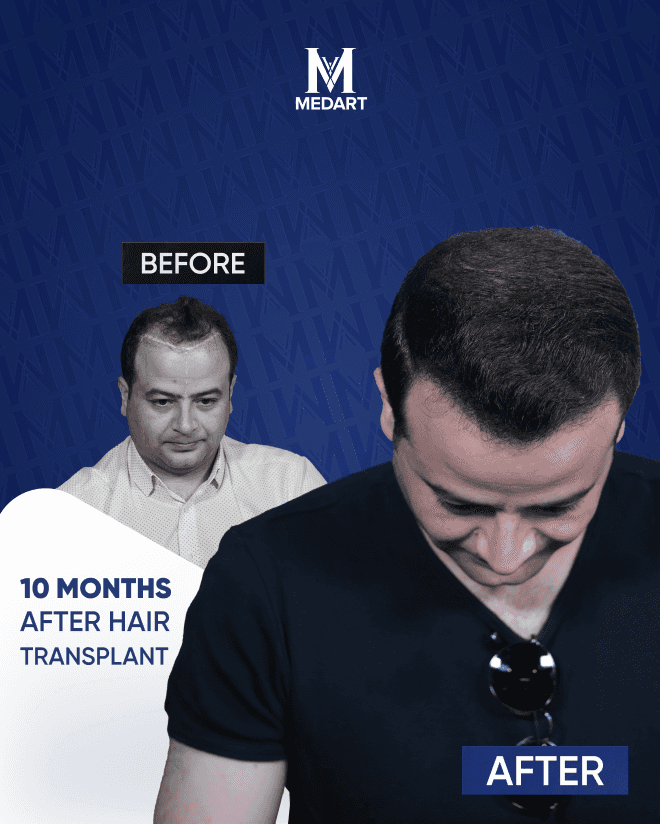 Before After 6