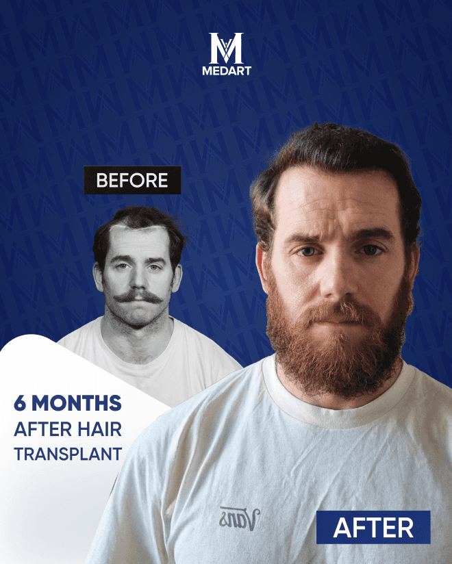 Before After 2